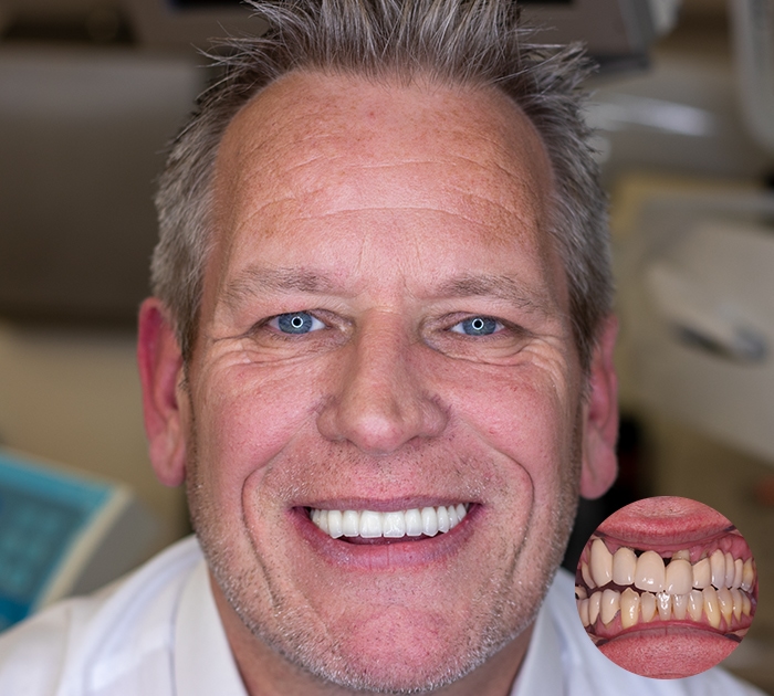 Fees After having Fees treatment
