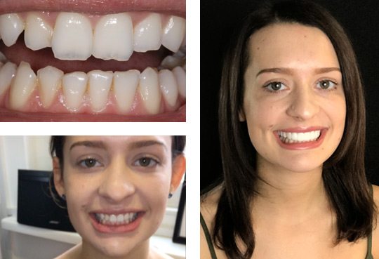 Braces After having Braces treatment